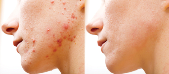 How to Remove Acne in Photoshop